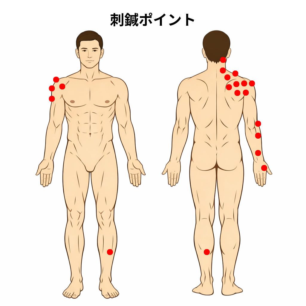五十肩の経穴イラスト